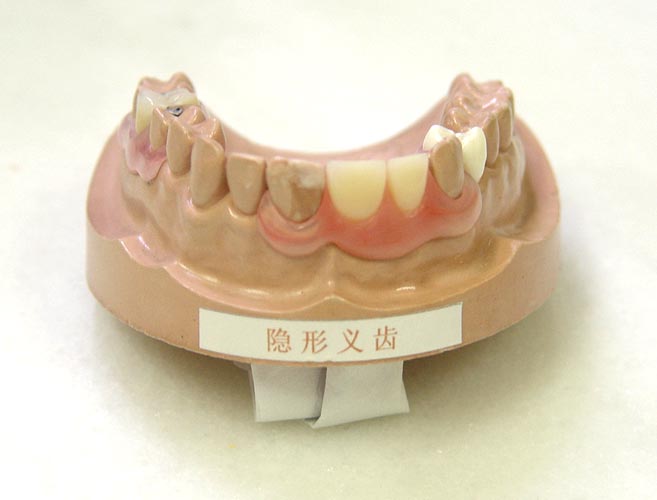 通过卡环固定在剩余天然牙上,同时,利用基托使义齿保持适当的位置行使